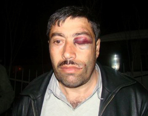 Tazakhan Miralamli after beating at the Yasamal District Police Division. Azerbaijan. Courtesy of the "Azadlyg" (Freedom) newspaper