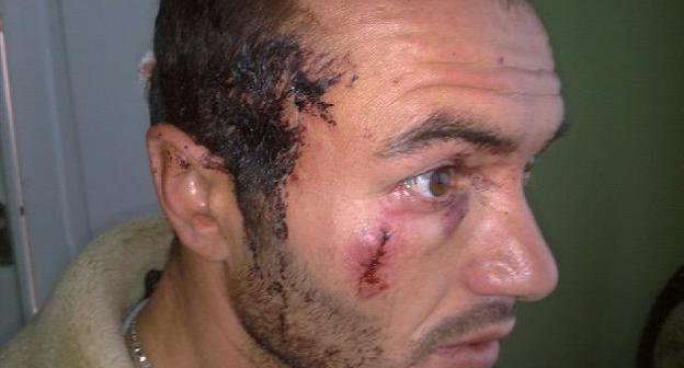 Dmitry Sobaev, a supporter of Alla Djioeva, who was beaten by unidentified persons on his way to Tskhinvali. Photo: uasamonga.ru