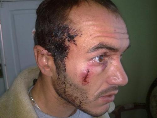 Dmitry Sobaev, a supporter of Alla Djioeva, who was beaten by unidentified persons on his way to Tskhinvali. Photo: uasamonga.ru